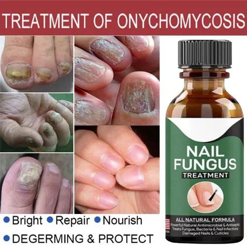 fast-nail-fungal-treatments-nail-repair-essences-serum-care-treatments-foot-nail-fungus-removal-gel-4 – 1