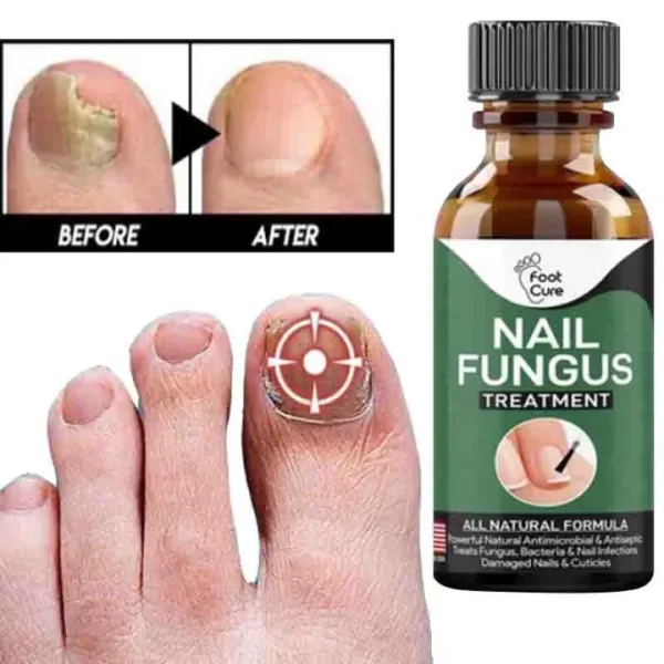 fast-nail-fungal-treatments-nail-repair-essences-serum-care-treatments-foot-nail-fungus-removal-gel-4 – 3