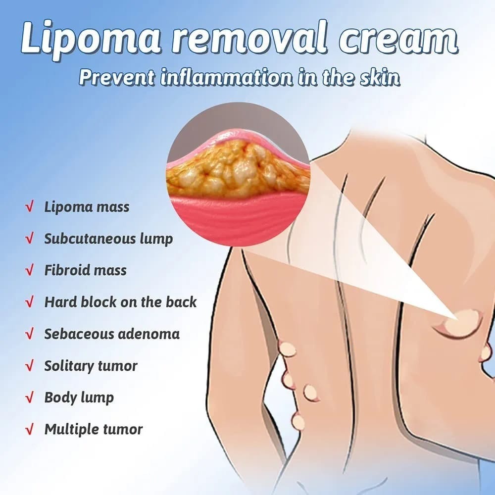 South Moon Lipoma Removal And Body Smoothing Cream 50g Herbal Natural Lump And Skin Knot Relief Ointment
