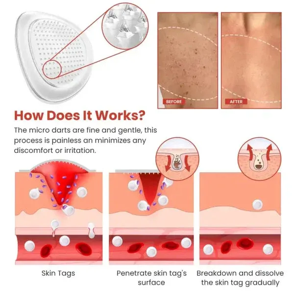 DermaSmooth Skin Tag Remover Patch Fast, Safe, And Painless Skin Tag And Mole Removal Solution With No Scarring Or Pigmentation - Image 4
