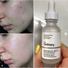 The Ordinary Niacinamide 10% + Zinc 1 % - 30ml |Oil Control, Pore Minimizing & Blemish Solution Serum - Image 4