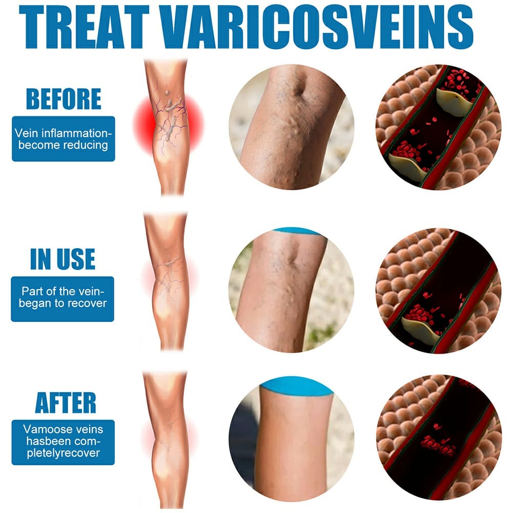 South Moon Varicose Veins Treatment Spray – 30ml Advanced Formula for Spider Veins, Leg Pain & Swelling Relief | Natural Herbal Spray for Better Circulation - Image 2