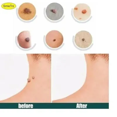 DermaSmooth Skin Tag Remover Patch 40 Pcs – Adhesive Skin Tag Care Patches - Image 5