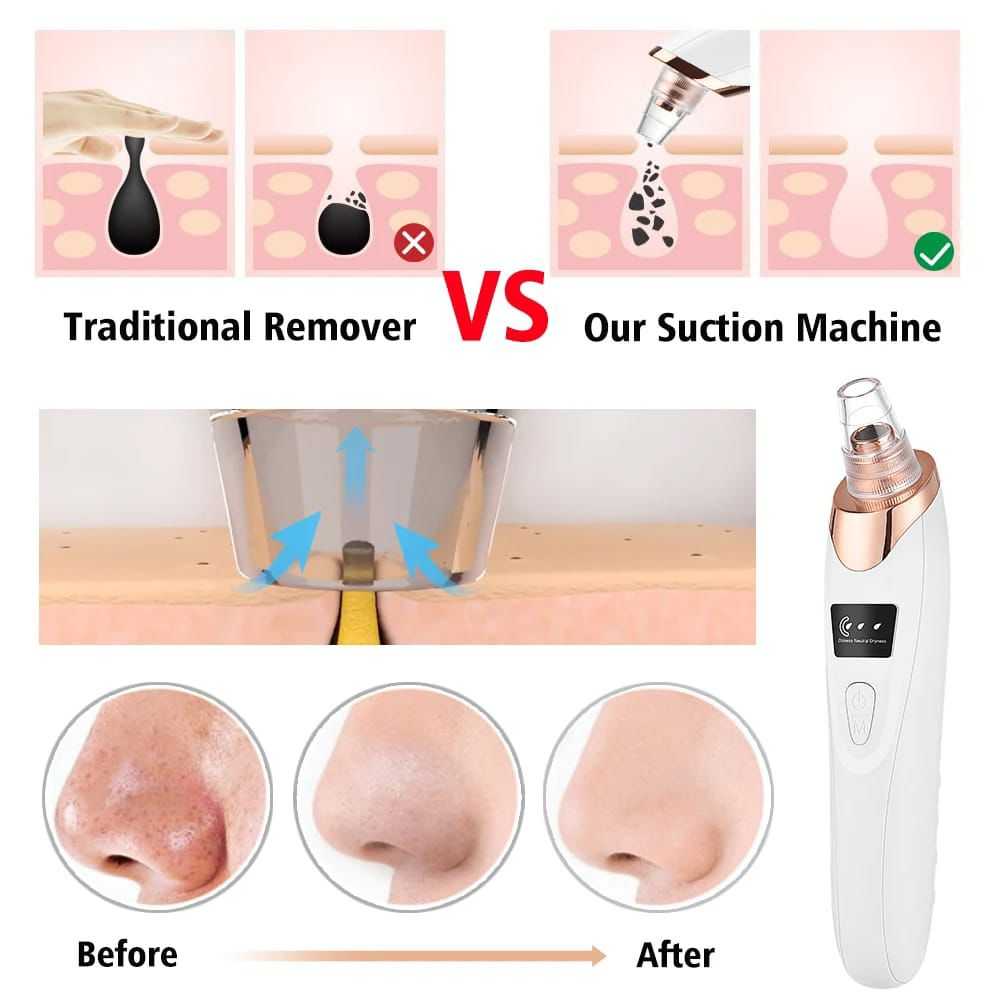 Electric Blackhead Remover Vacuum โ Professional Pore Cleaner with Acne Needle & Skin Care Kit - Image 4